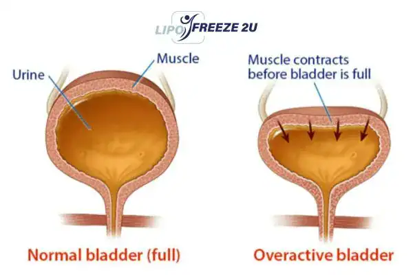diagram of overactive bladder treatment Bingley