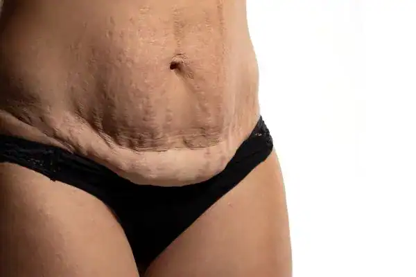 loose skin after weight loss injections Bingley
