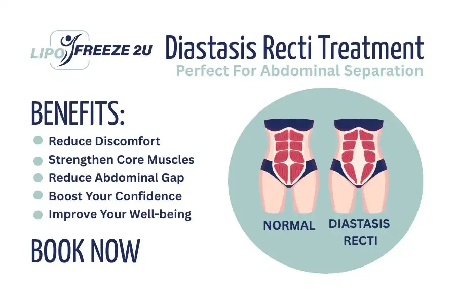 Benefits of body toning treatment Bingley for Diastasis recti