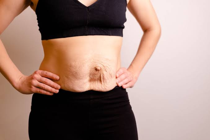 Is Surgery Really the Only Way to Repair Diastasis Recti Bingley?